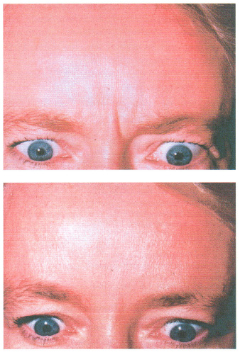 over the counter eye drops for infection over the counter eye drops for infection